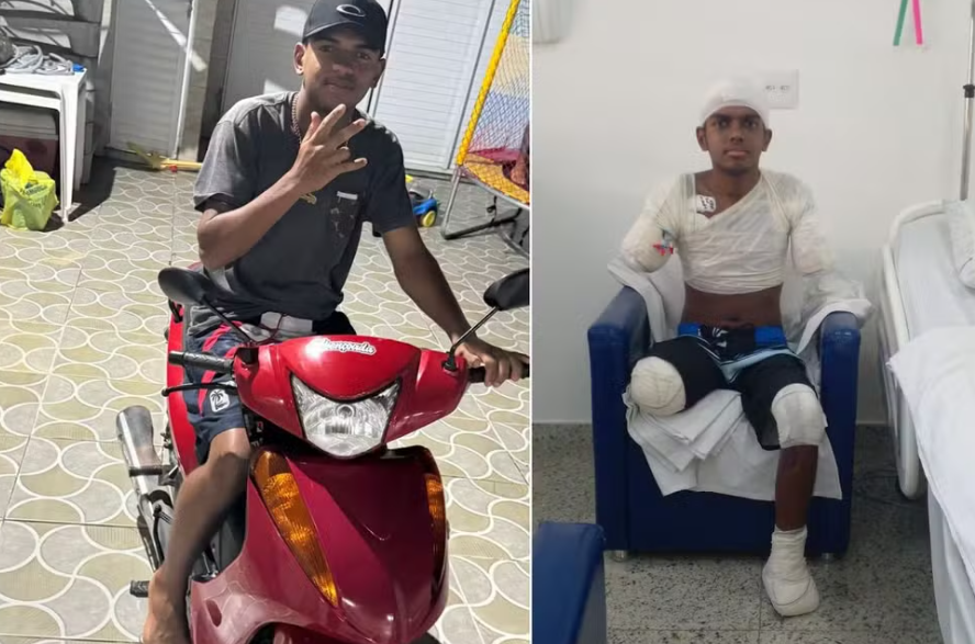 Adolescente tem braços, perna e parte de pé amputados após levar choque de alta voltagem